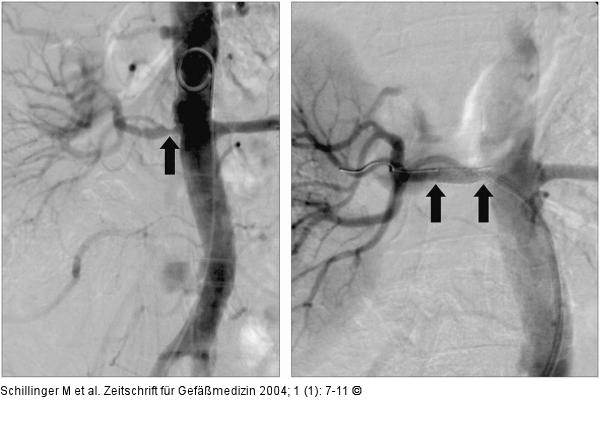 Perkutane Angioplastie - Stentimplantation