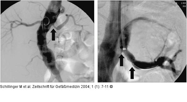Perkutane Angioplastie  - Stentimplantation
