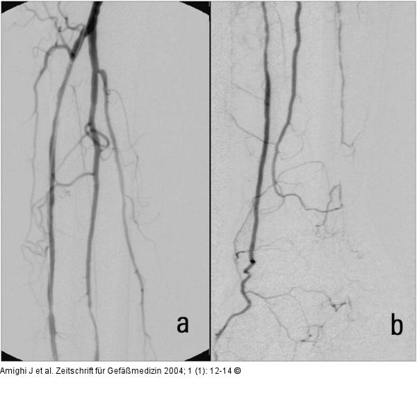 Lysetherapie - Abschluangiogramm