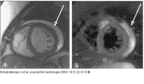 Kardiale Magnetresonanztomographie