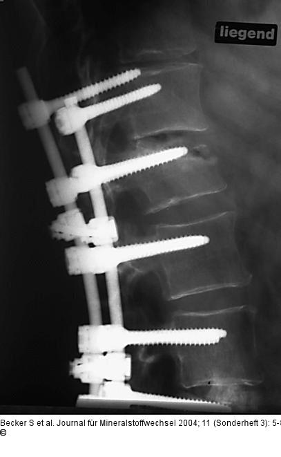 Kyphoplastie - Augmentationstechnik