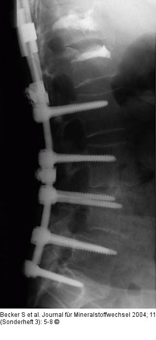 Kyphoplastie - Augmentationstechnik
