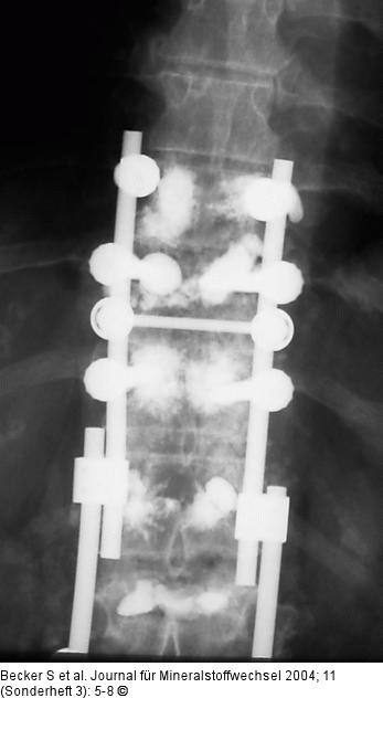 Kyphoplastie - Augmentationstechnik