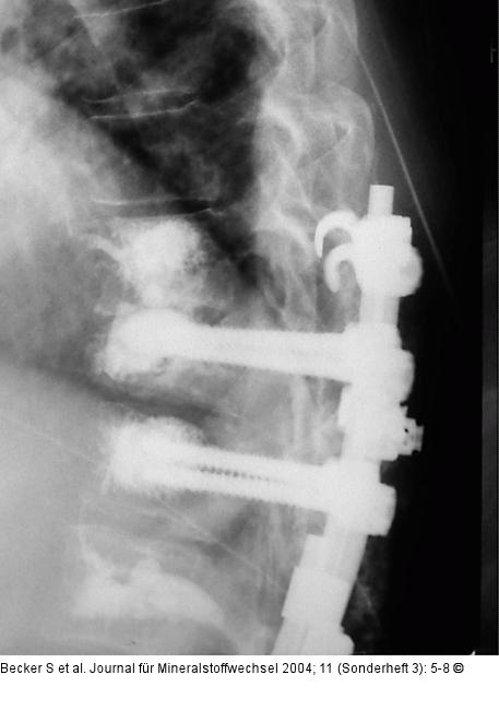 Kyphoplastie - Augmentationstechnik