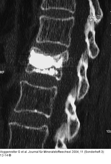Zementverteilung - Postoperativ