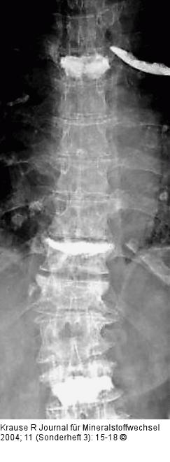 Vertebroplastien - Kyphoplastie