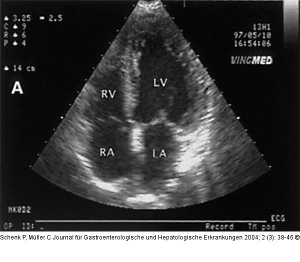 Hepatopulmonales Syndrom - Fallbericht