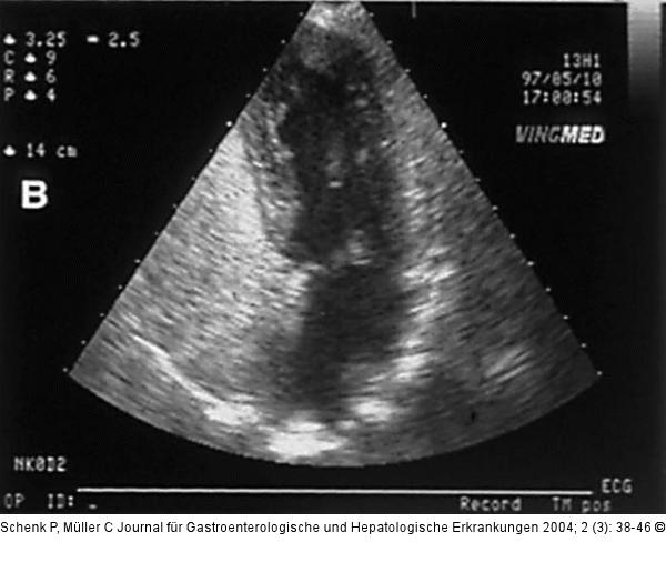 Hepatopulmonales Syndrom - Fallbericht