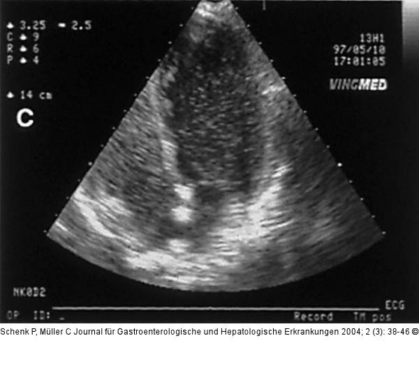 Hepatopulmonales Syndrom - Fallbericht
