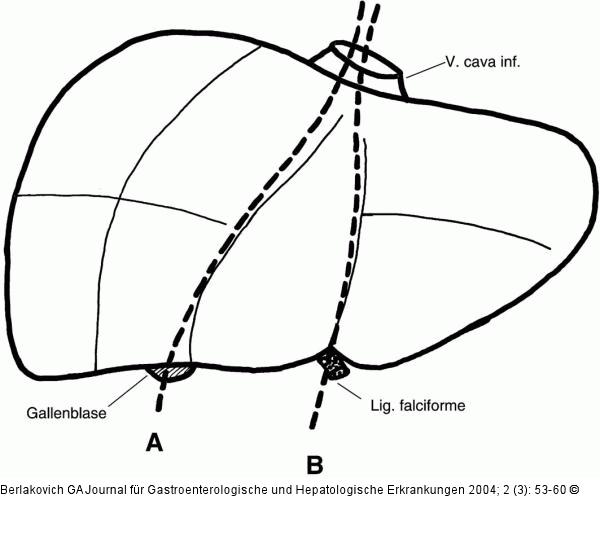 Hemihepatektomie - Lobektomie