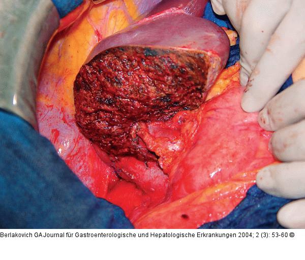 Lebertransplantation - Spenderoperation