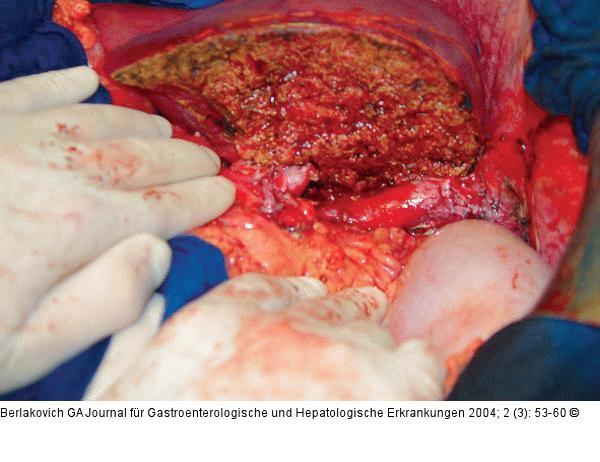 Lebertransplantation - Empfngeroperation