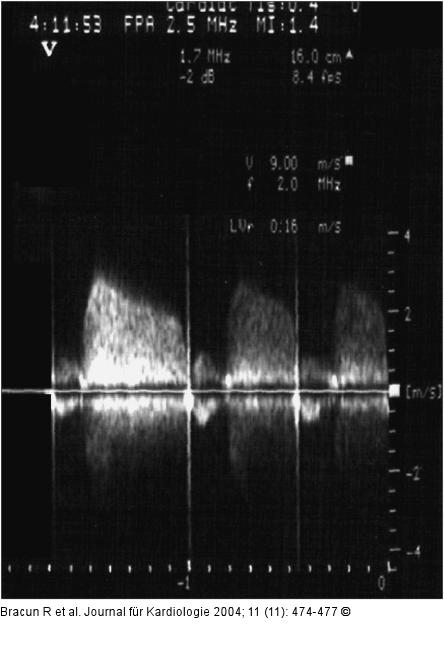 Echokardiographie - Prothesenffnung