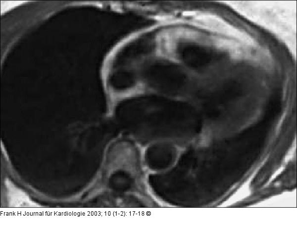 Kardiale Magnetresonanztomographie