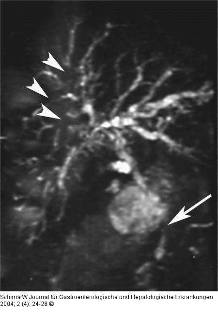 Primr Sklerosierende Cholangitis