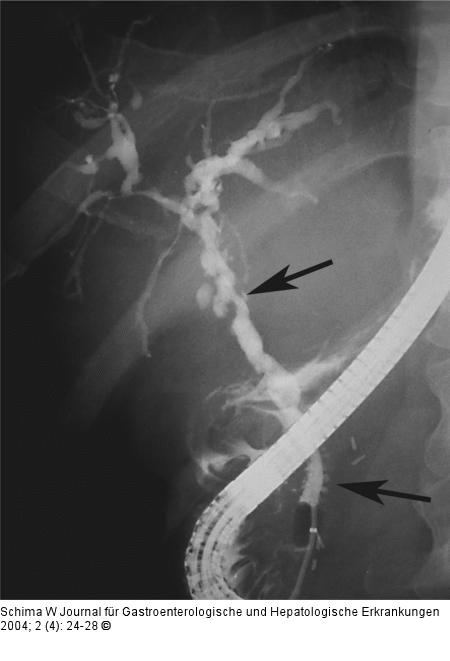 Primr Sklerosierende Cholangitis