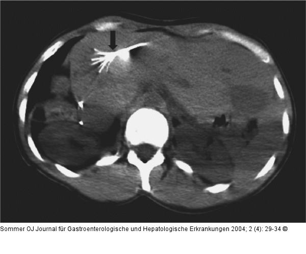 Radiofrequenzablation - Tumor