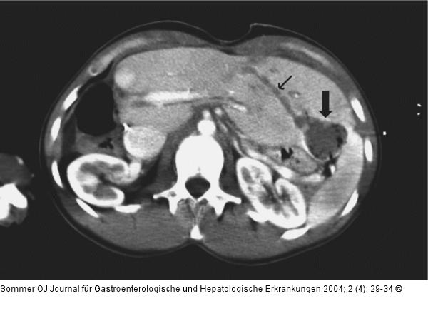 Radiofrequenzablation - Tumor