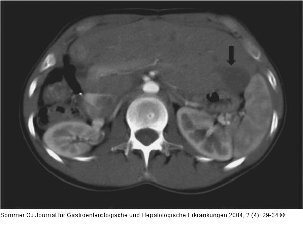 Radiofrequenzablation - Tumor