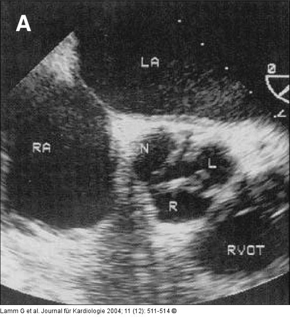 Aortenklappenstenose