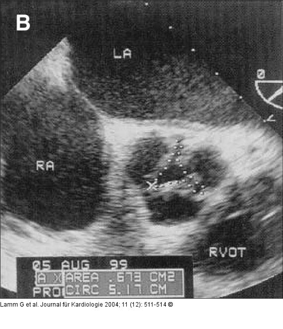 Aortenklappenstenose