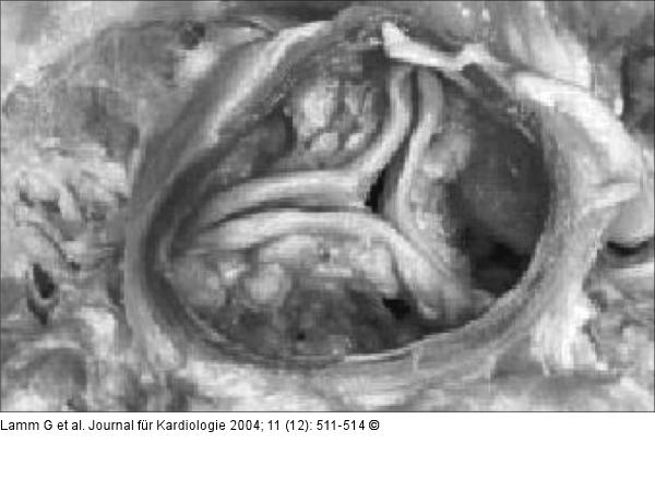 Aortenklappenstenose - Operationssitus