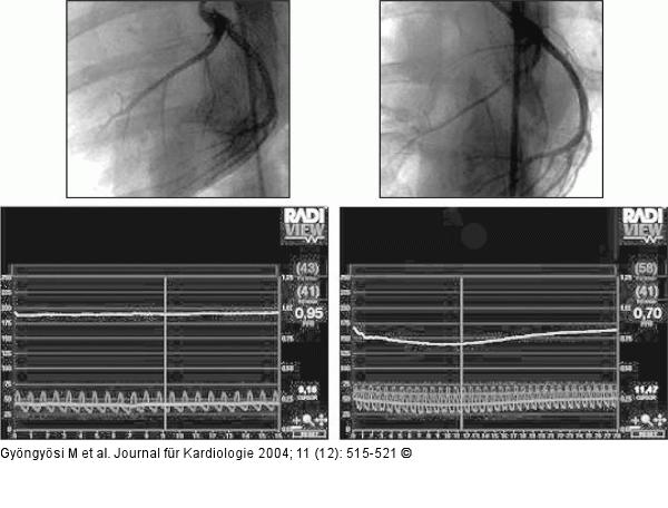 In-Stent-Stenose - Pressure-Wire-Untersuchung