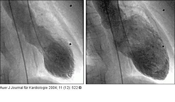 apical  balloning