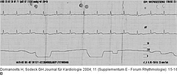 Normofrequenter Sinusrhythmus