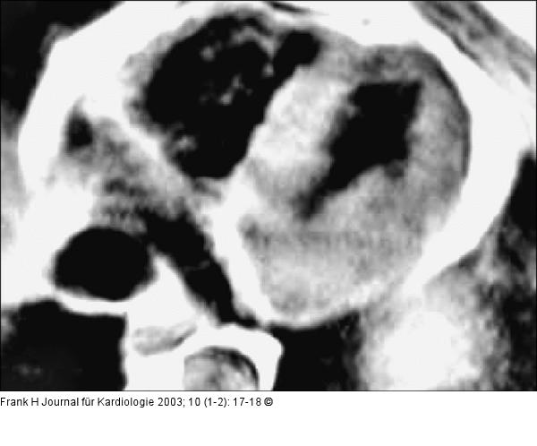 Kardiale Magnetresonanztomographie