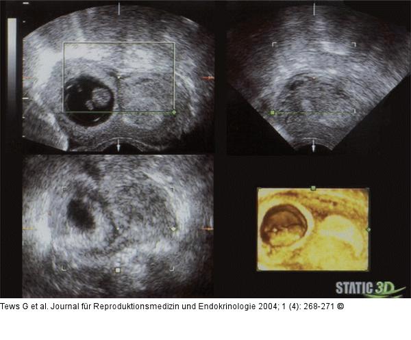 Embryo - 3D-Ultraschall