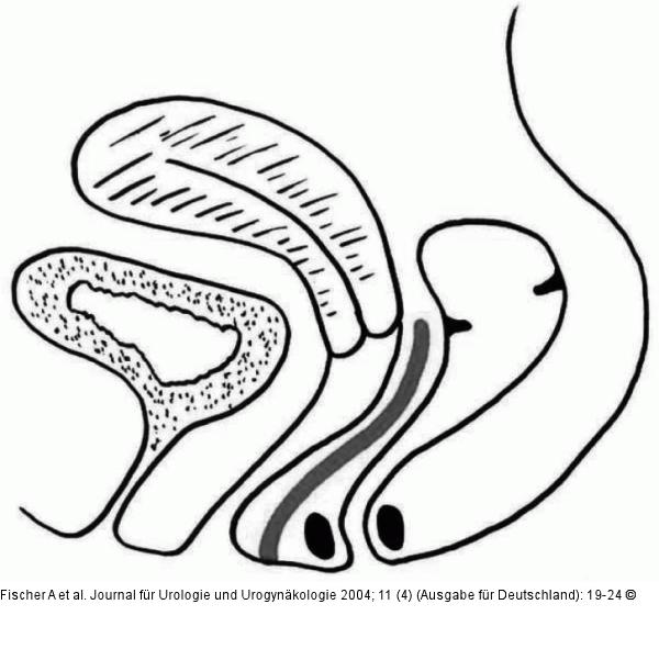 Septum rectovaginale