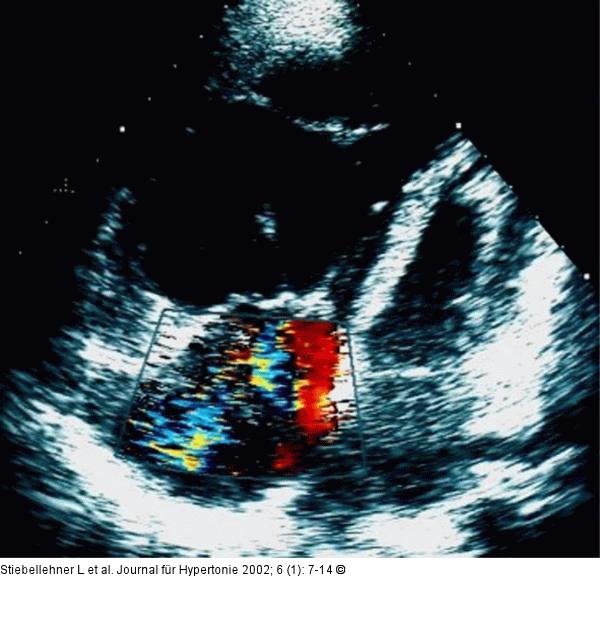 Pulmonale Hypertonie