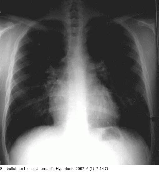 Pulmonale Hypertonie