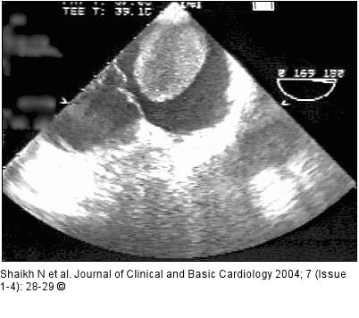 Transesophageal Echocardiography