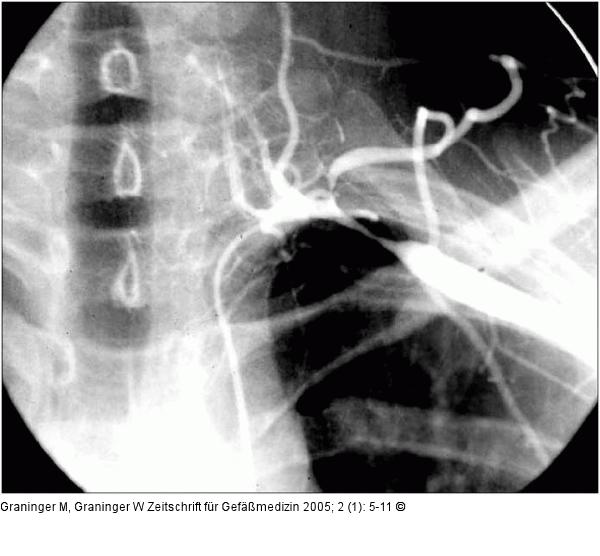 Takaysu-Arteriitis