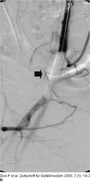 Pseudoaneurysma - Ballonokklusion