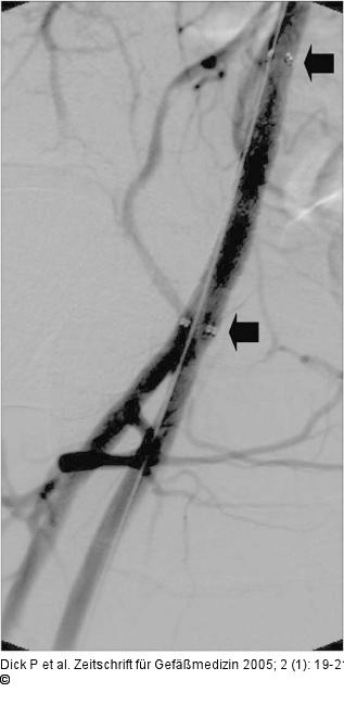 Stentgraft-Implantation