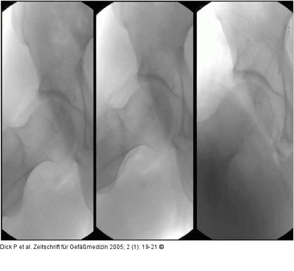 Stengraft