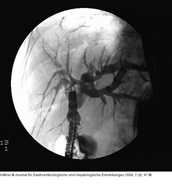 Ductus hepaticus