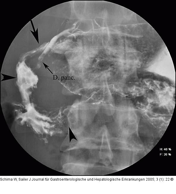 Morbus Crohn - Duodenum