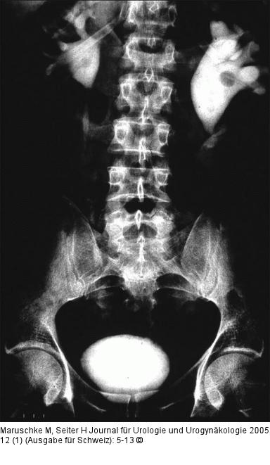 Ureterkarzinom