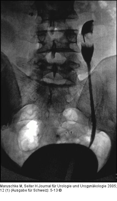 Ureterkarzinom