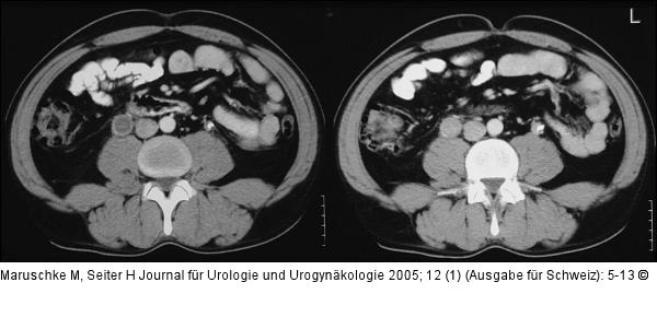 Ureterkarzinom
