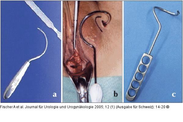 Transobturatorielle Schlingensysteme