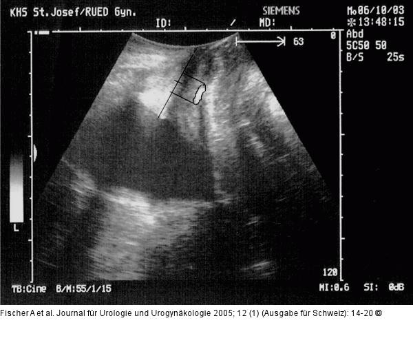 Transobturatorielles Band im perinealsonographischen
