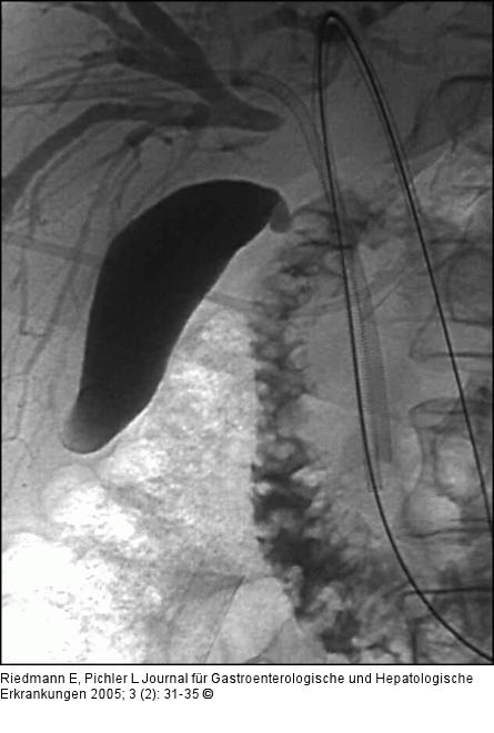 Bilaterale Drainage