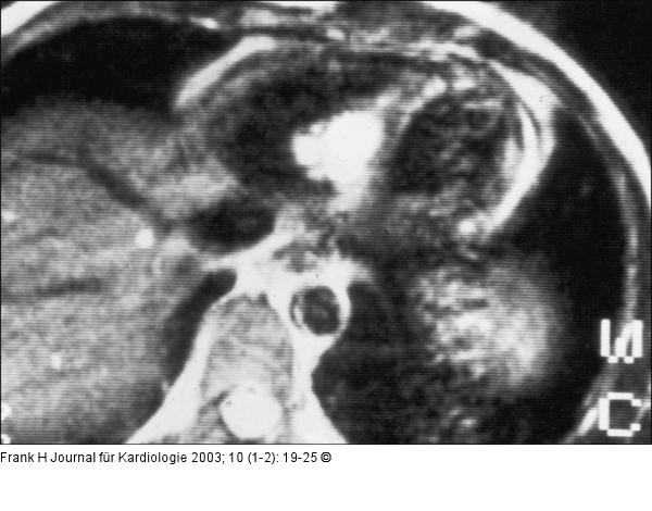 Cardiac Magnetic Resonance Imaging