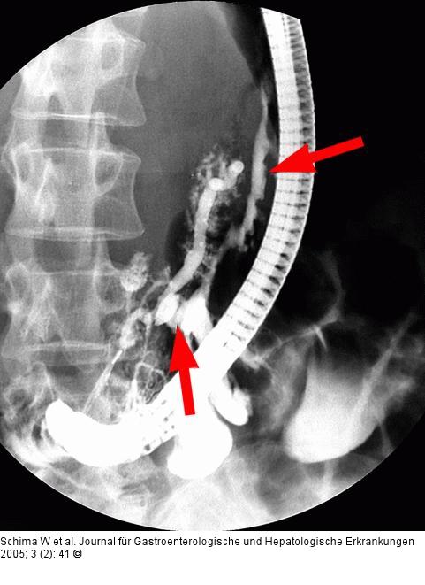 Fistel vom D. pancreaticus in die Bursa omentalis reichend