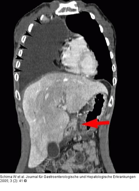 Coronale MDCT-Rekonstruktion der Fistel